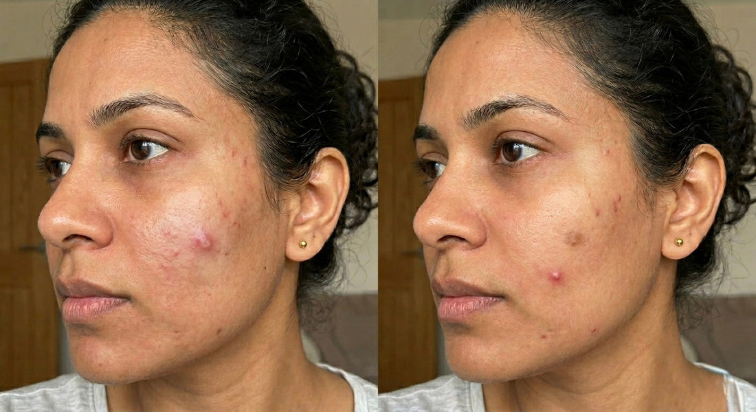 The Real Reason Your Acne Keeps Coming Back (It’s Not What You Think)
