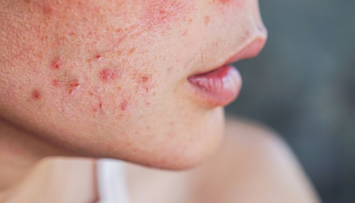 Top-5-Skincare-Ingredients-to-Treat-Acne LUMAÈ