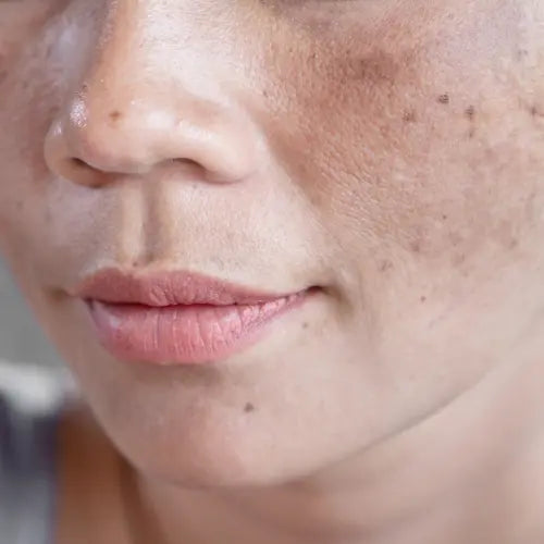 Hyperpigmentation LUMAÈ