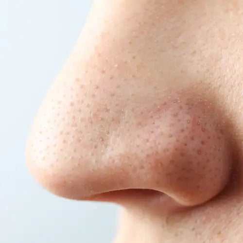 Blocked Pores LUMAÈ