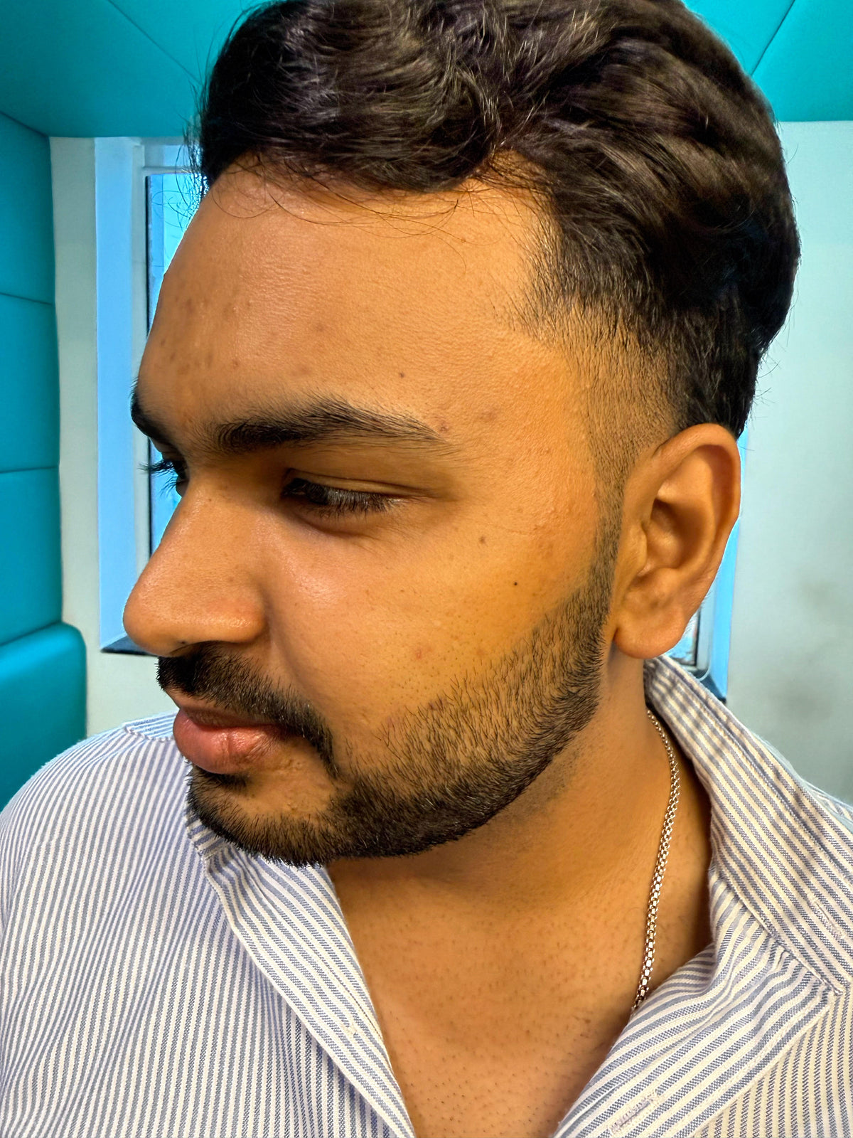 Same customer after 7 days of using LUMAÈ anti-acne serum