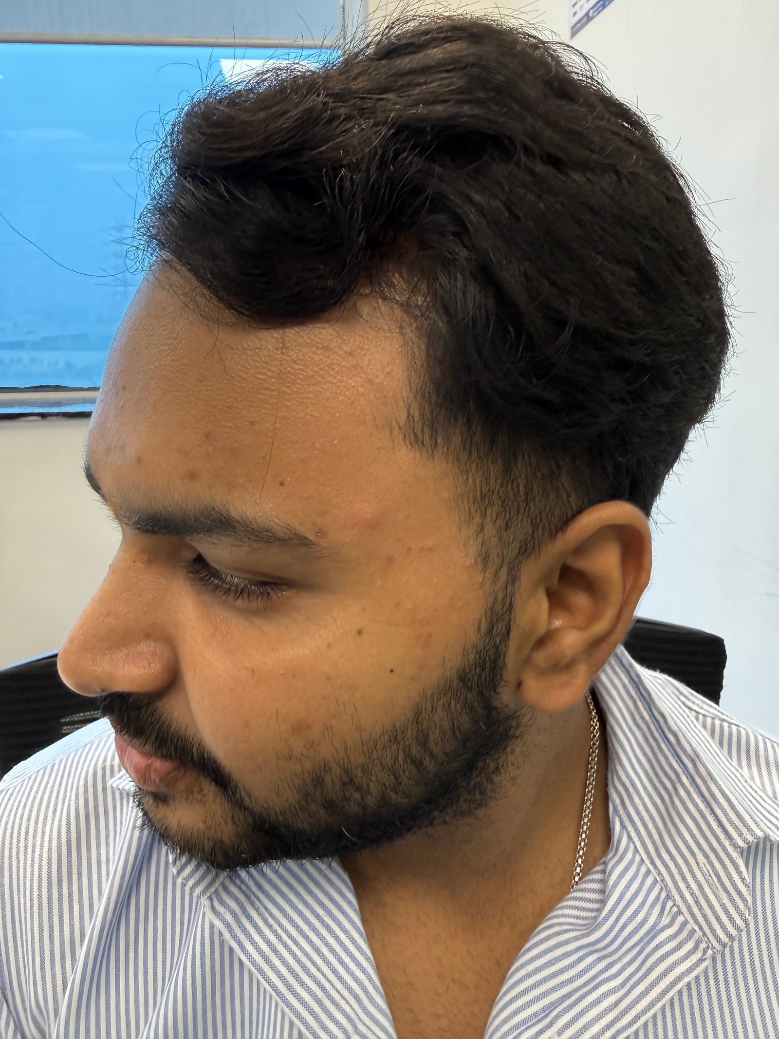 Customer skin before using LUMAÈ anti-acne serum, day 1